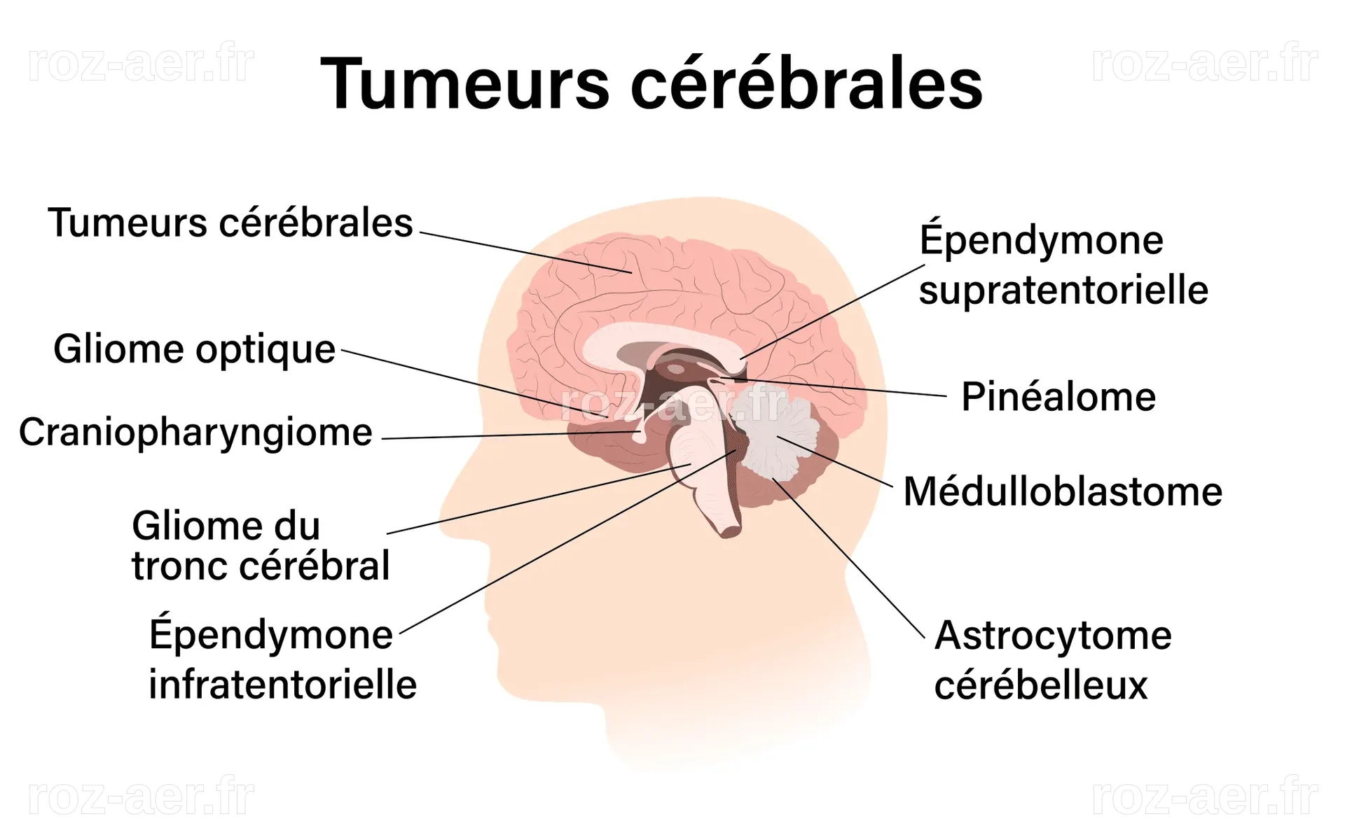 Les tumeurs au cerveau : causes, symptômes et traitements