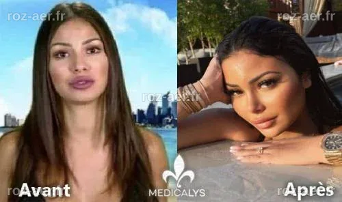 Maeva Ghennam : Beauté Transformée par la Chirurgie | Medicalys