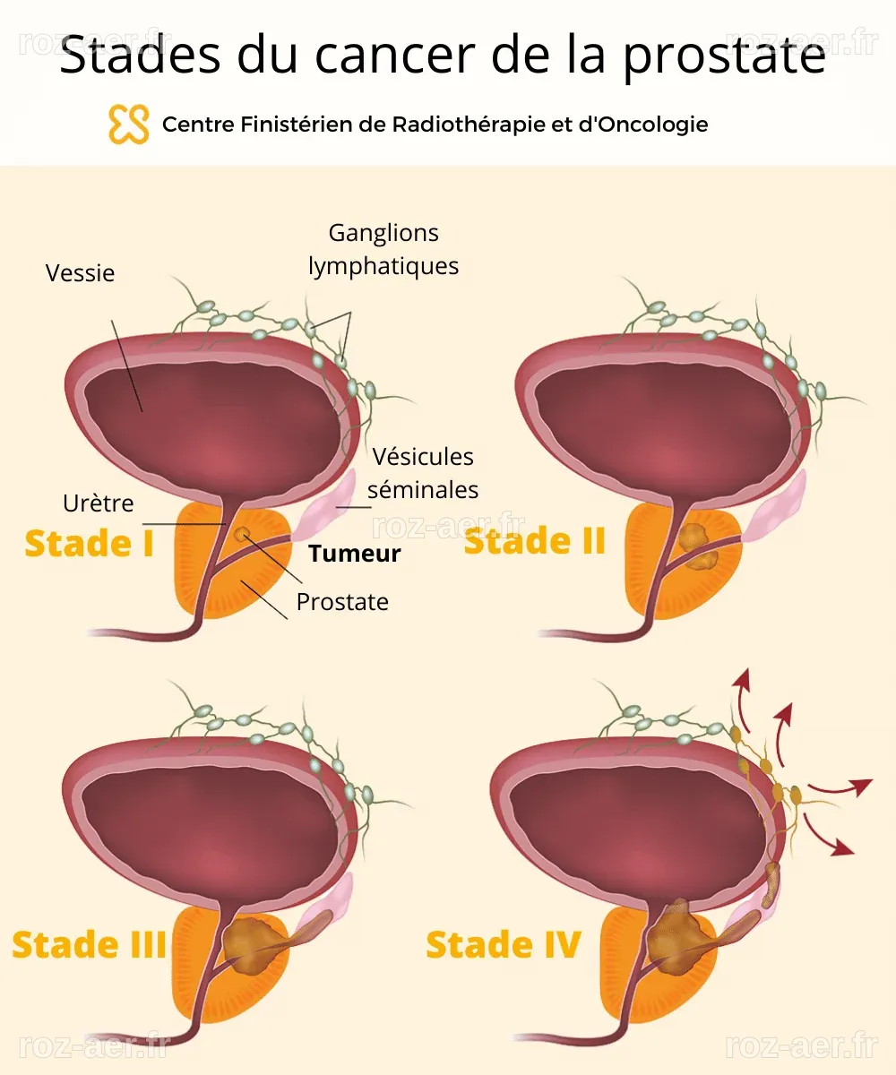 Un Ouvrier du Bâtiment de 40 Ans Diagnostiqué d'un Cancer de la Prostate Terminal Après des 'Douleurs Mineures' : 'Pourquoi Moi ?'