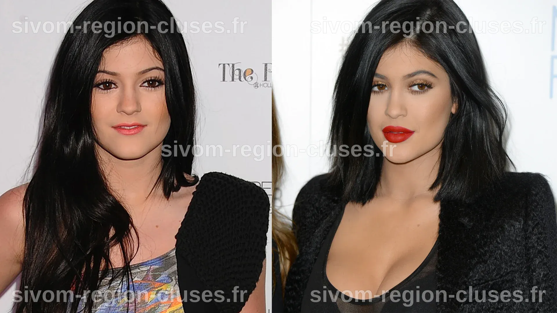 Kylie Jenner : son évolution beauté avant après la chirurgie esthétique ...