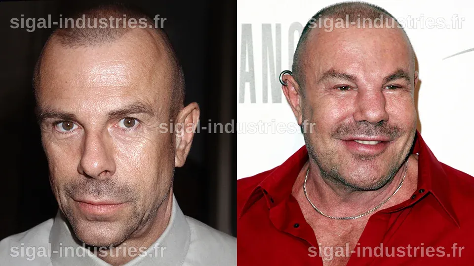 L'accident tragique de Thierry Mugler : une transformation visage inoubliable