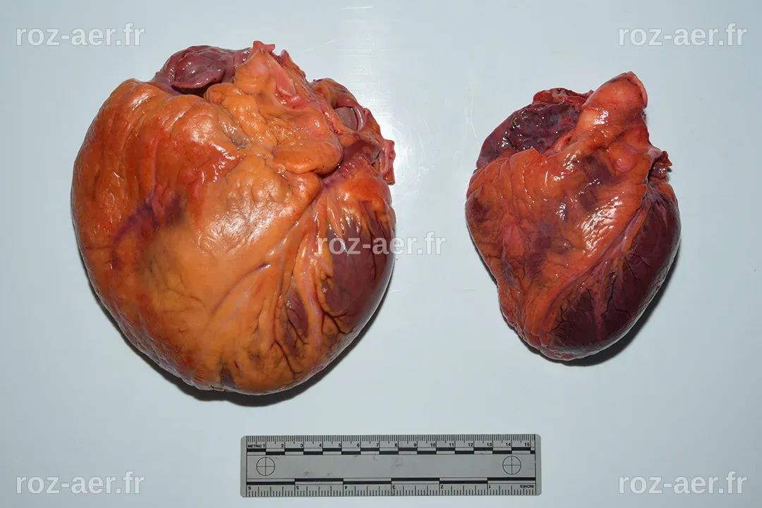 Enlarged Human Heart Enlarged Heart: Symptoms And Causes | Bottom Line