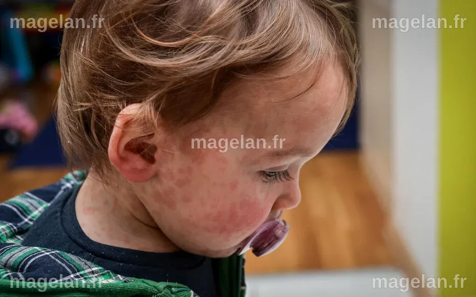 Un mort, ministre antivax… La reprise de rougeole aux États-Unis doit ...