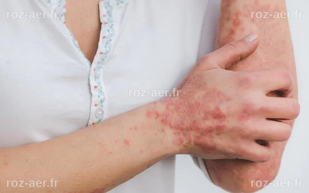 Toutes les informations à savoir sur l’eczéma nerveux