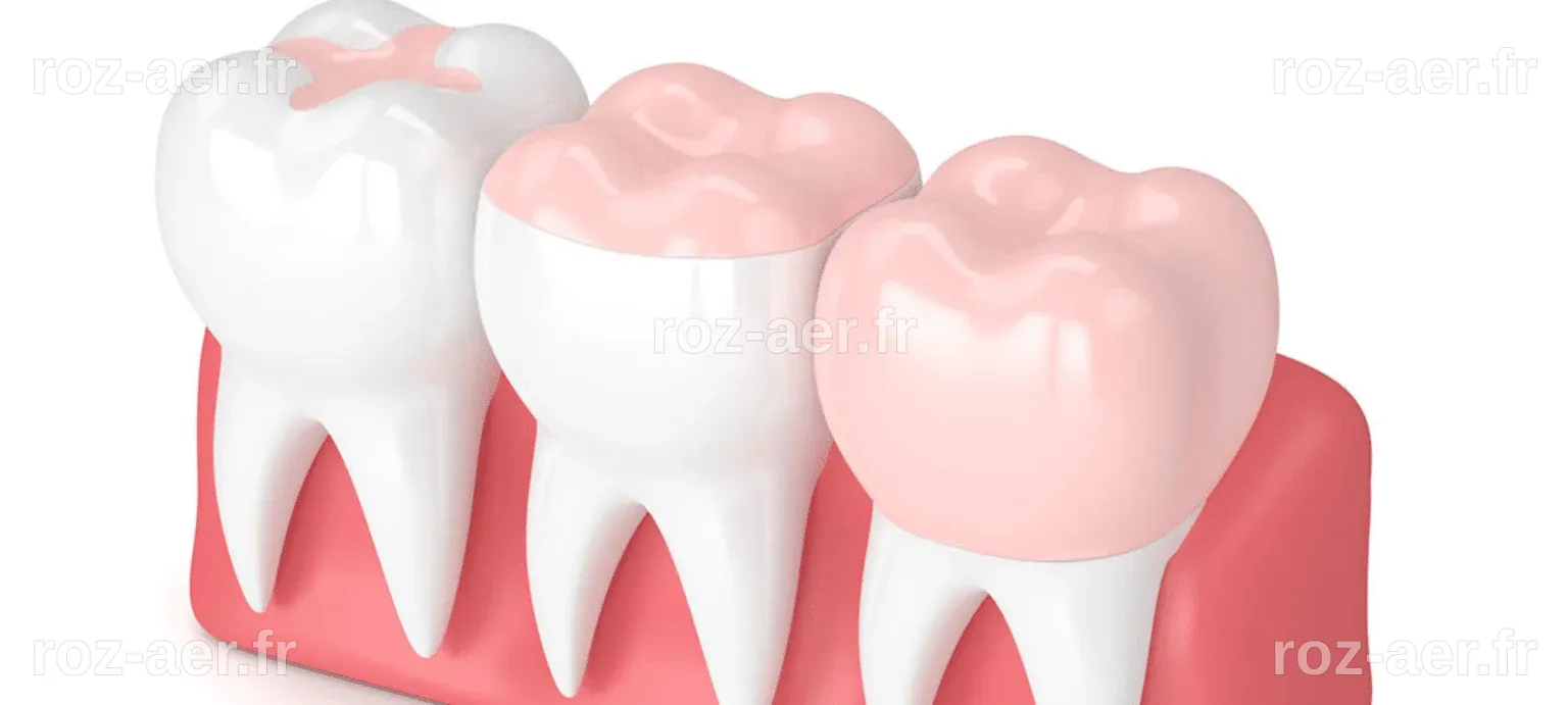 Composite Esthétique : Un Regard Approfondi - Paris Dental Studios