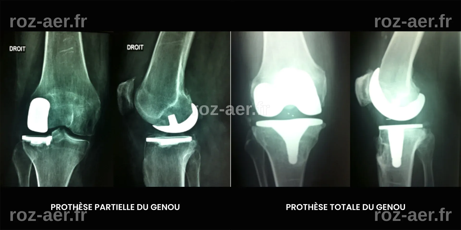 Prothèse Totale/Partielle du genou et Exerthérapie Redéfinissent la ...