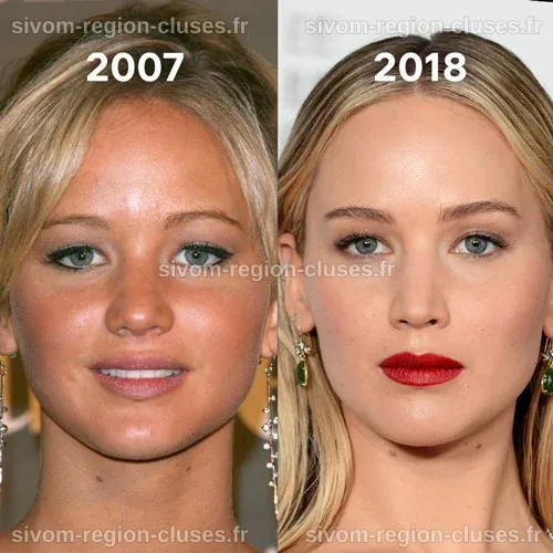 Jennifer Lawrence et la chirurgie esthétique