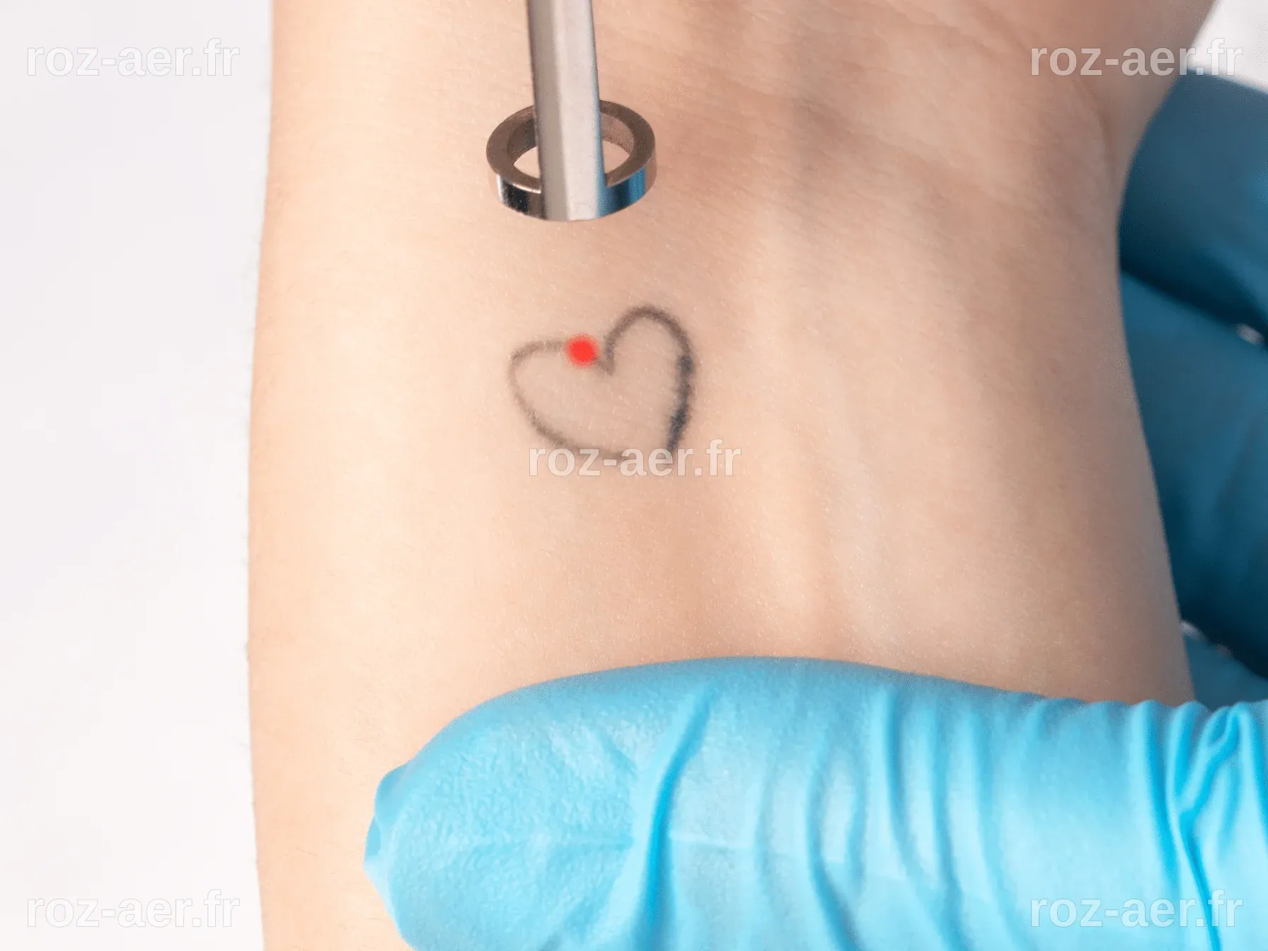 Détatouage au laser : comment ça marche et à quoi s'attendre ? - My Laser