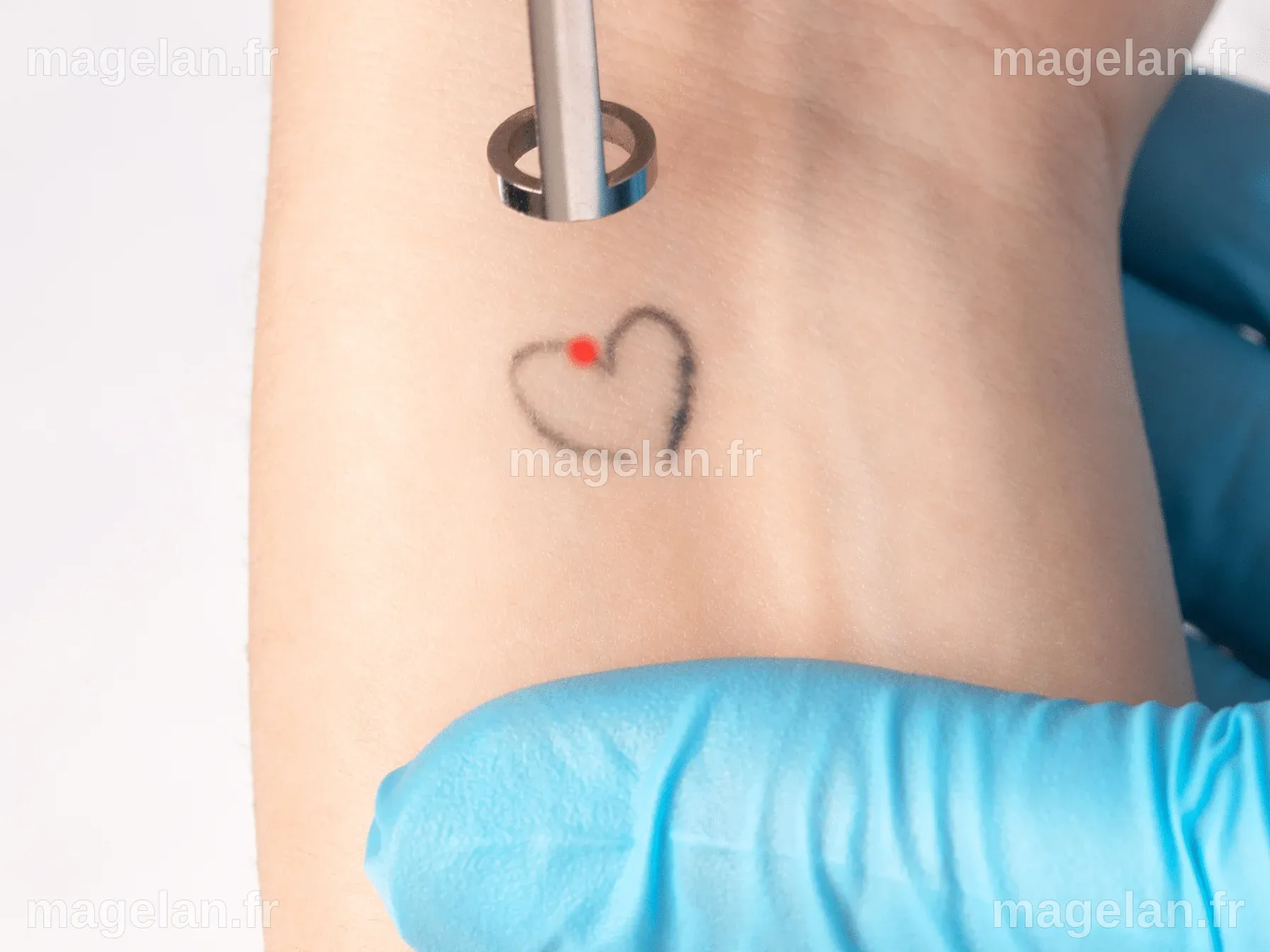 Détatouage au laser : comment ça marche et à quoi s'attendre ? - My Laser
