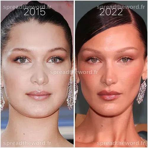 bella-hadid-avant-apres-bichectomie | Dr Skander HENDAOUI - Chirurgien ...