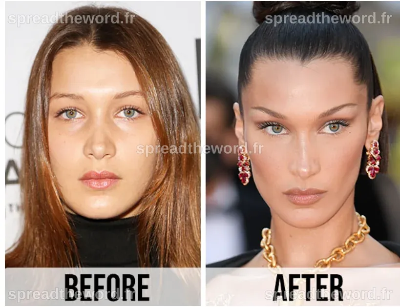 Bella Hadid Plastic Surgeries - Aesthetic Center Turkey