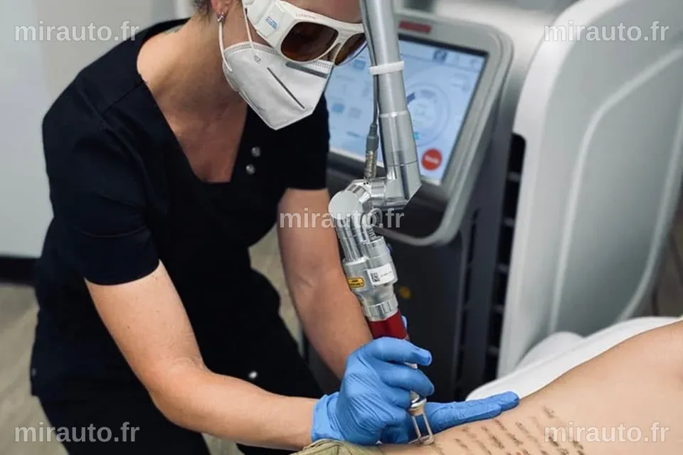 Épilation laser et détatouage : La science au service de notre corps