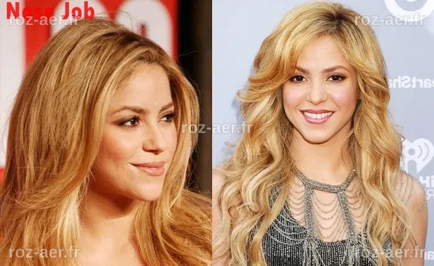 Combien de chirurgies esthétiques Shakira a-t-elle subies dans sa vie