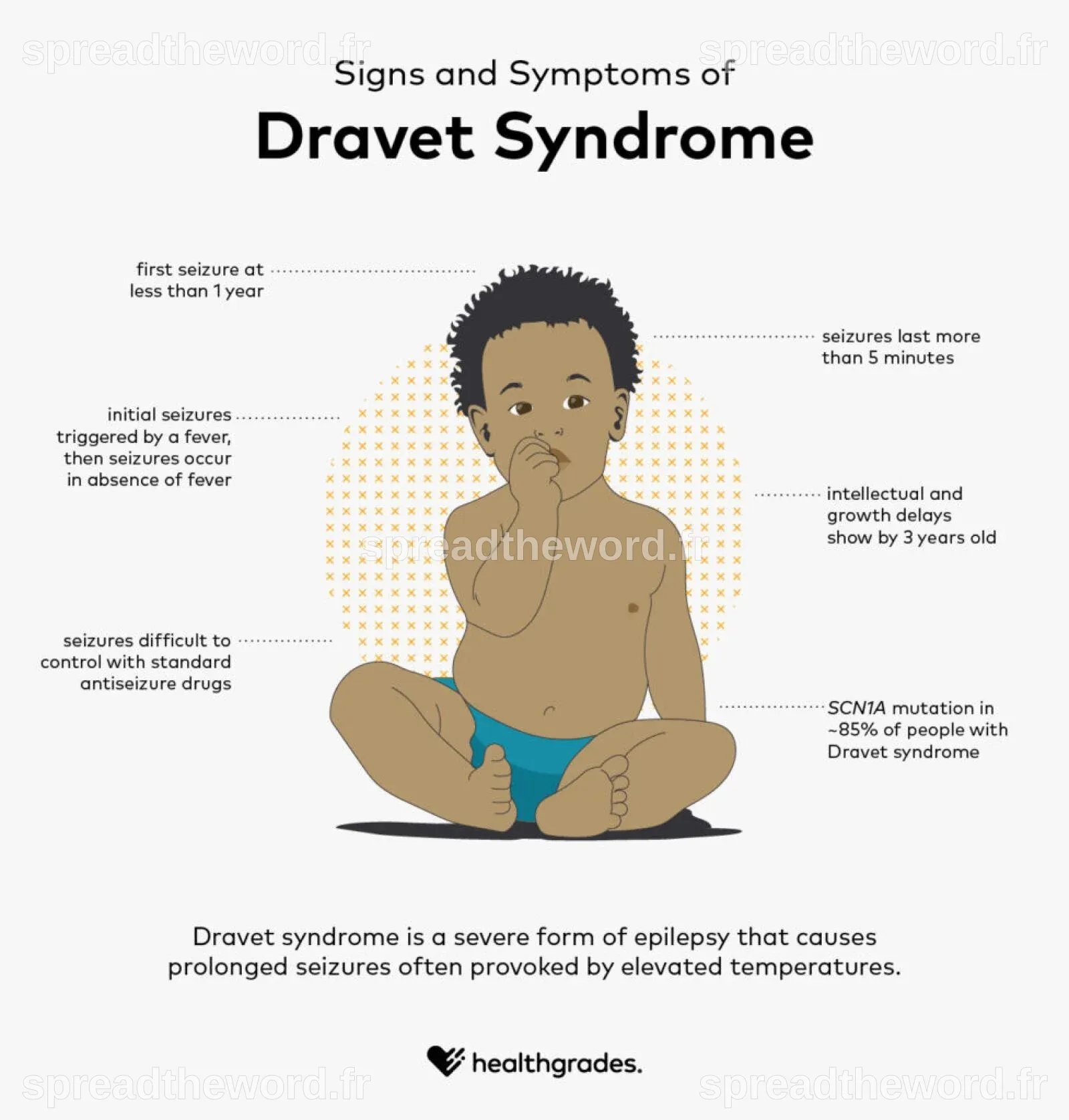 Dravet Syndrome: Symptoms, Diagnosis, Management