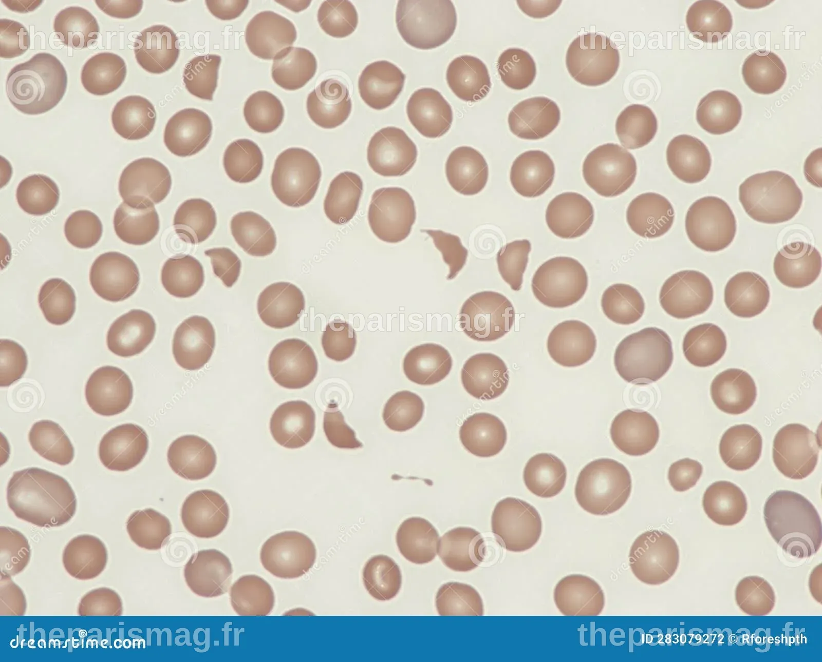 Schistocytes (red Cell Fragments) in Peripheral Blood. Stock Photo ...